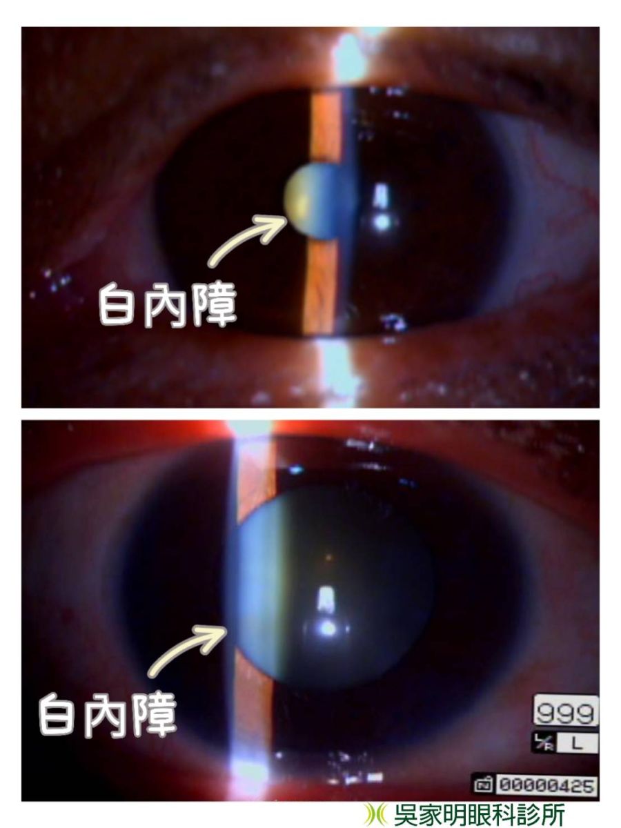 白內障手術  白內障症狀  白內障治療  白內障手術術後當天  白內障手術術後隔天