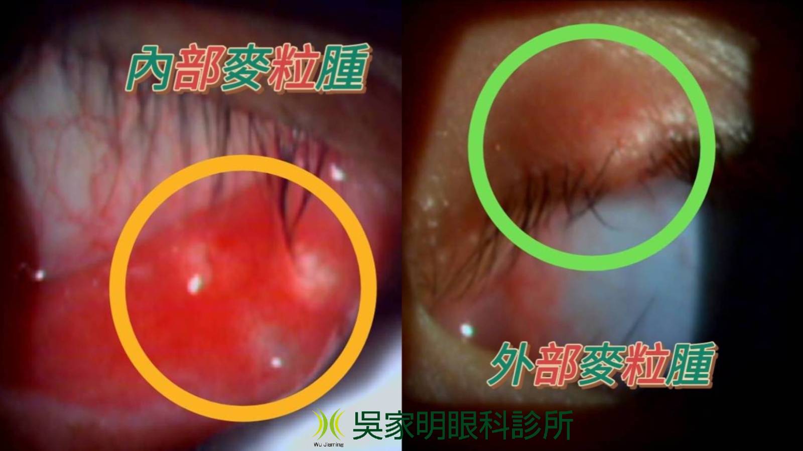 吳家明眼科  高雄眼科推薦   三民眼科推薦   麥粒腫 霰粒腫